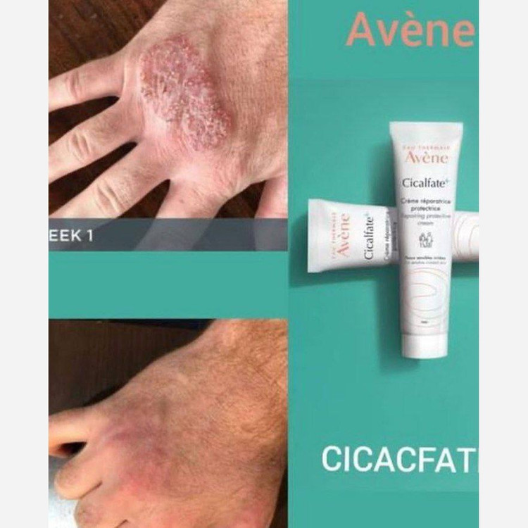 کرم ترمیم کننده سیکالفیت اون Avene Cicalfte+ (مدل جدید مخصوص بخیه)